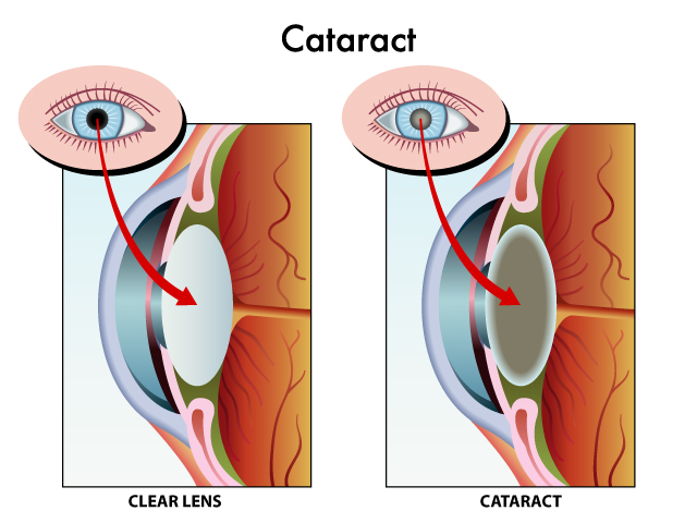 Determining the Need for Cataract Surgery: Expert Guidance from Dr. Seema Behl