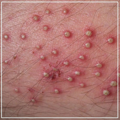 Folliculitis Treatment in Mumbai