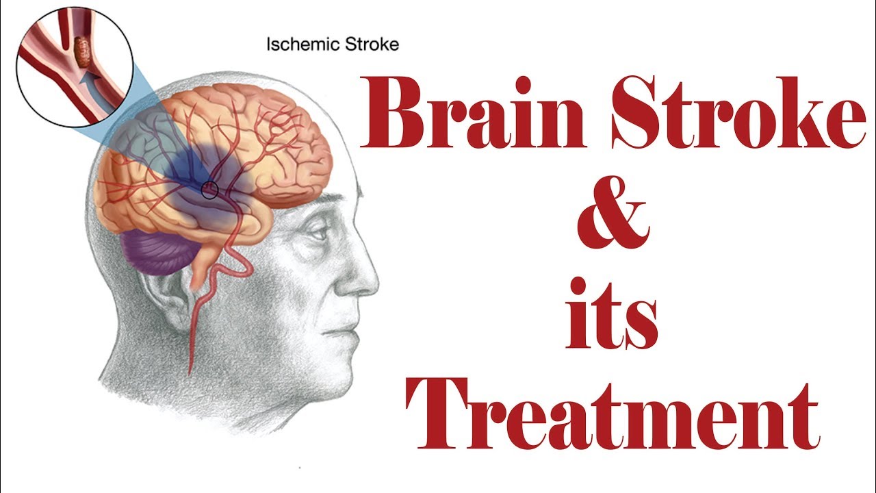 Brain Stroke Treatment in Goregaon | Dr. Amit Shah