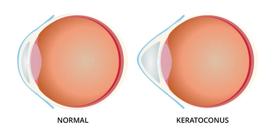 Dr. Seema Behl on Keratoconus: Post-treatment Progression Awareness.