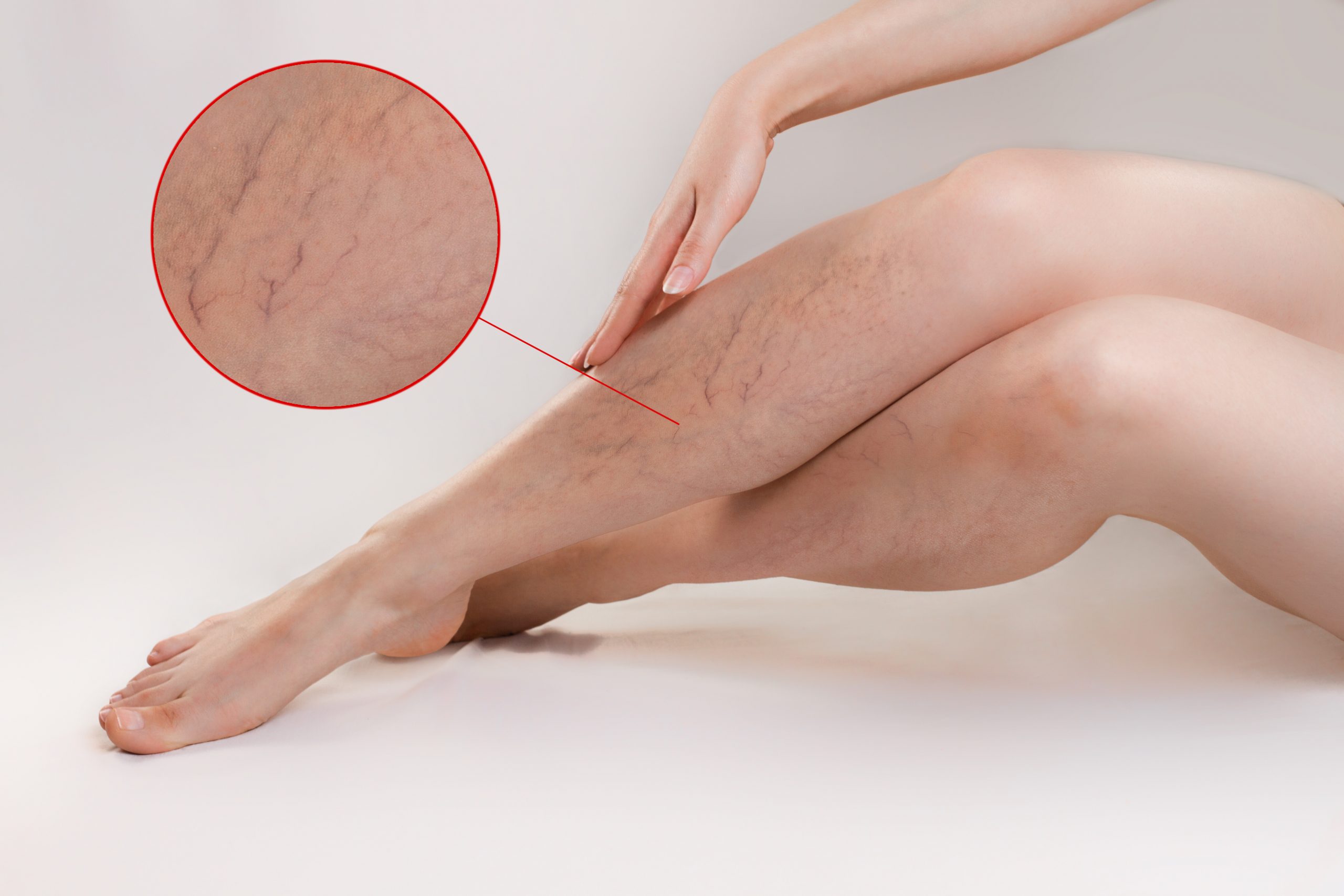 Painless Legs, Effortless Steps! Dr. Kunal Arora’s Varicose Vein Treatment, Your Path to Comfort.