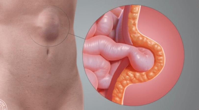 Advanced Laparoscopic Hernia Surgery in Mumbai with Dr. Bhavesh Doshi