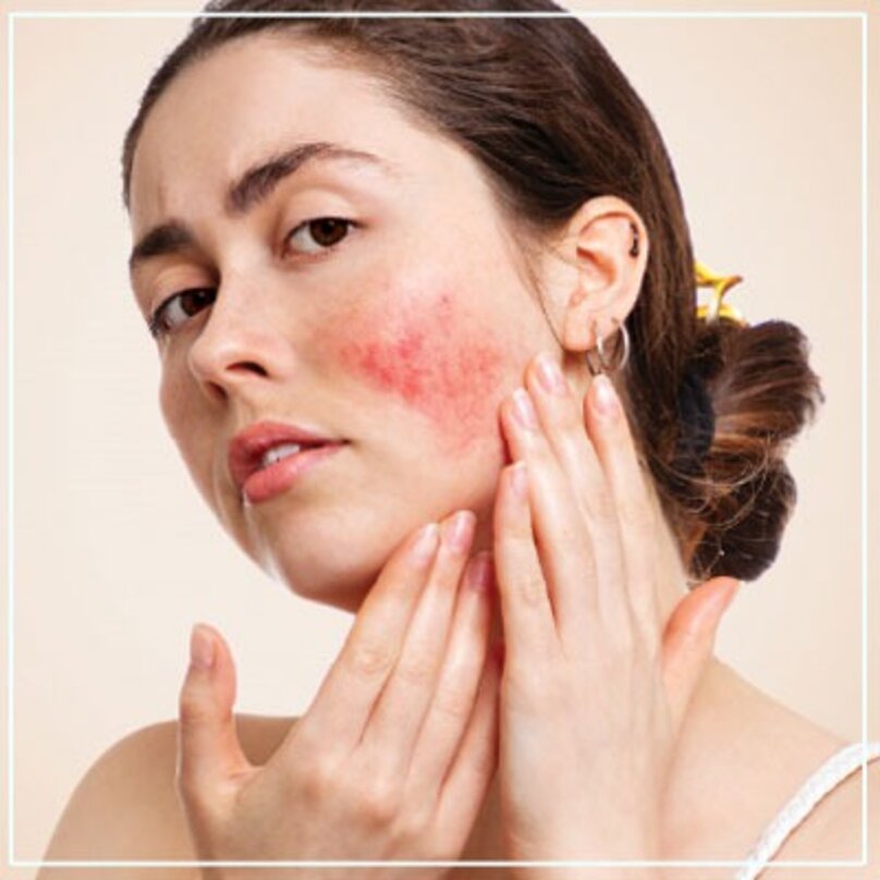 Expert Rosacea Treatment in Mumbai with Dr. Deepam Shah