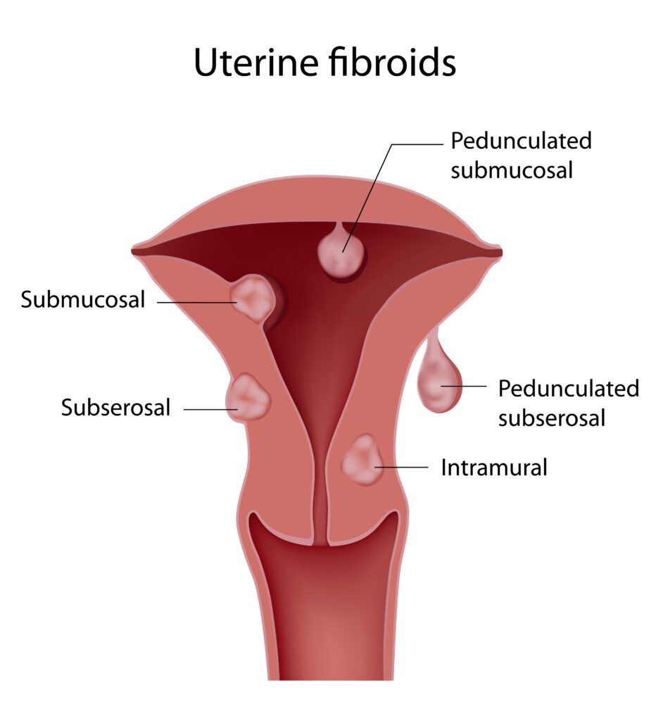 Best Doctor for Fibroid Surgery/Removal Treatment in Dubai: Trust Dr. Neha Lalla Doctor Near Me
