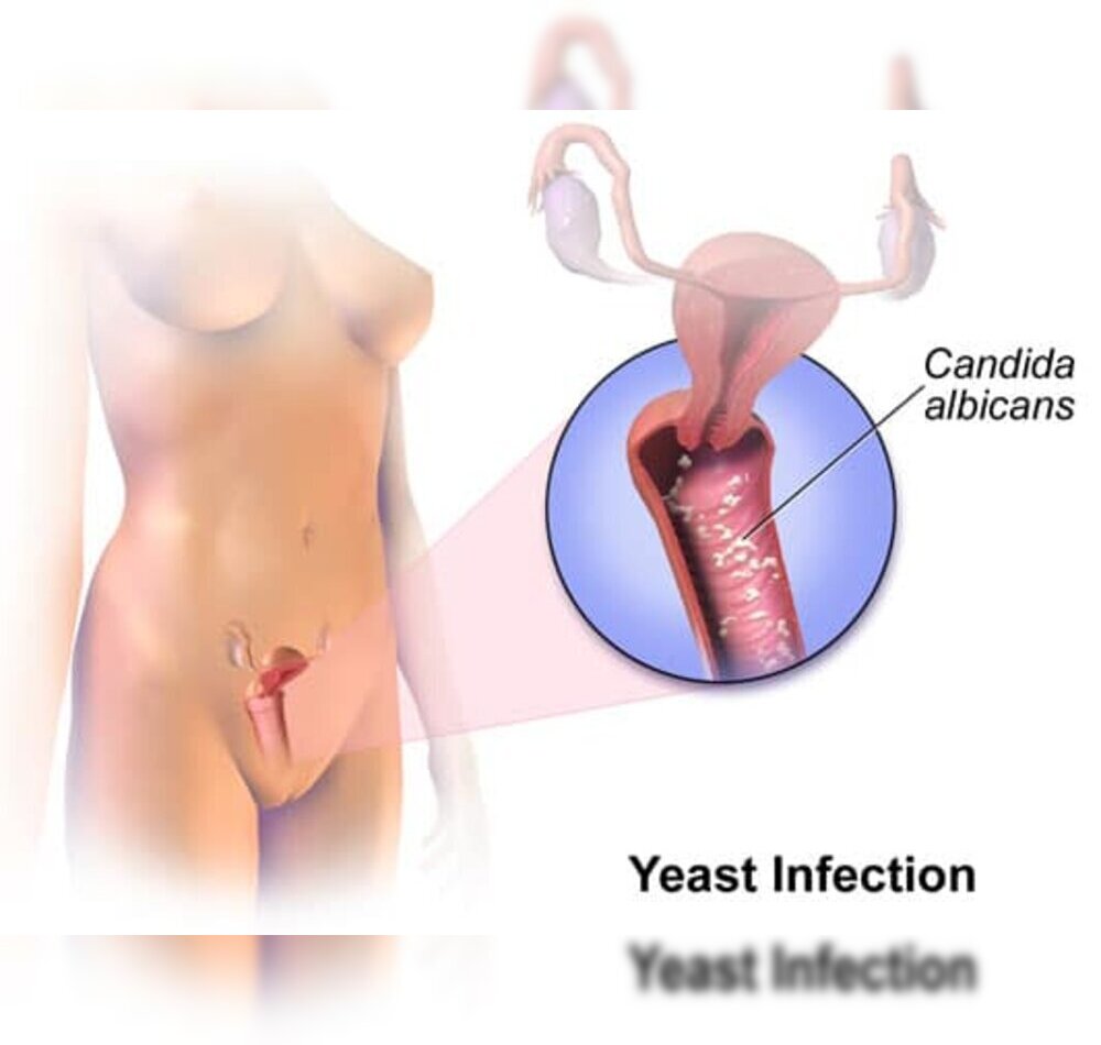 Vaginal Infection Treatment in Thane with Dr. Arohi Tasgaonkar