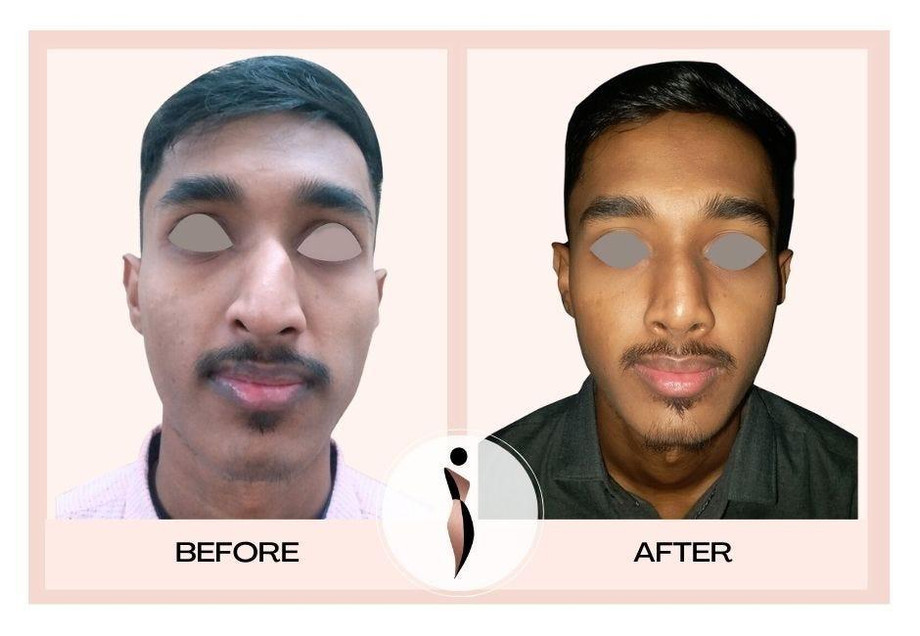 Best Rhinoplasty Surgeon in India (Nose Job) with Dr. Amiti Shah