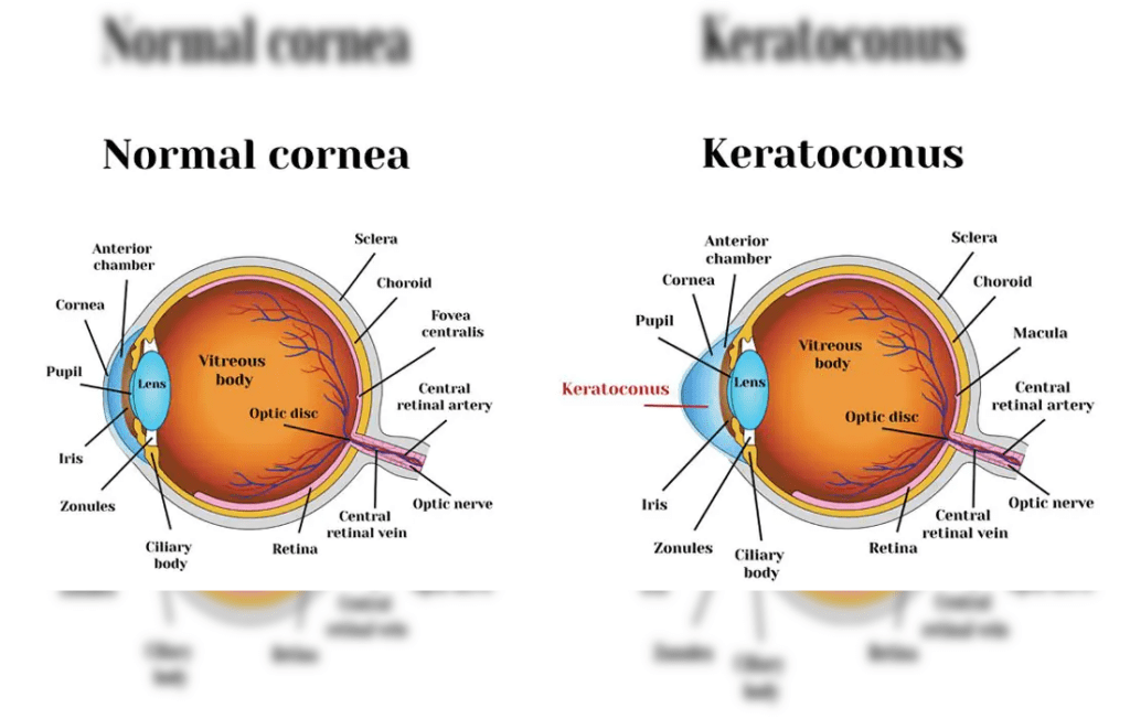 Expert Keratoconus Treatment in Andheri, Mumbai with Dr. Seema Behl Doctor Near Me