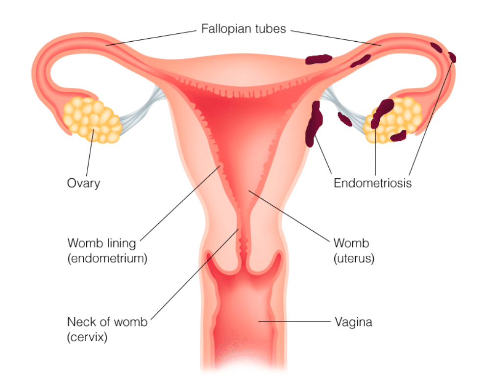 Understanding Endometriosis Operation in Dubai with Dr. Neha Lalla