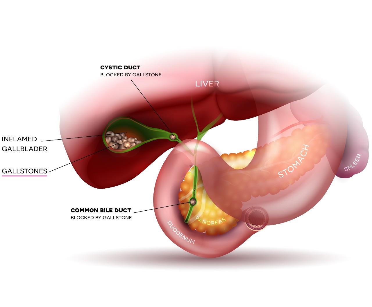 Effective Gallstone Treatment in Mumbai: Expert Care at Globus Hospital