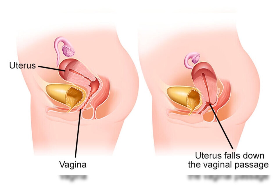 Uterine Prolapse Treatment in Dahisar: Restoring Your Health and Confidence