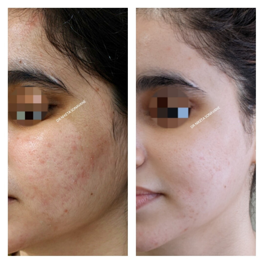 Skin Whitening Treatment in Mumbai by Dr. Niketa Sonavane
