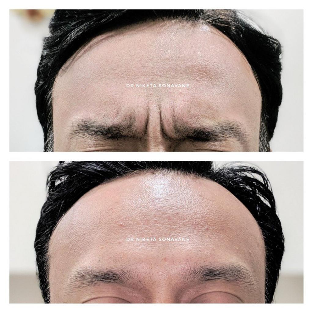 Botox Treatment in Mumbai