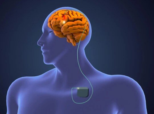 cost of dbs surgery in mumbai india cost of dbs surgery in mumbai india