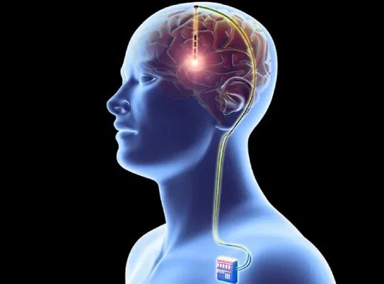 Deep Brain Stimulation Surgery in Mumbai Deep Brain Stimulation Surgery in Mumbai
