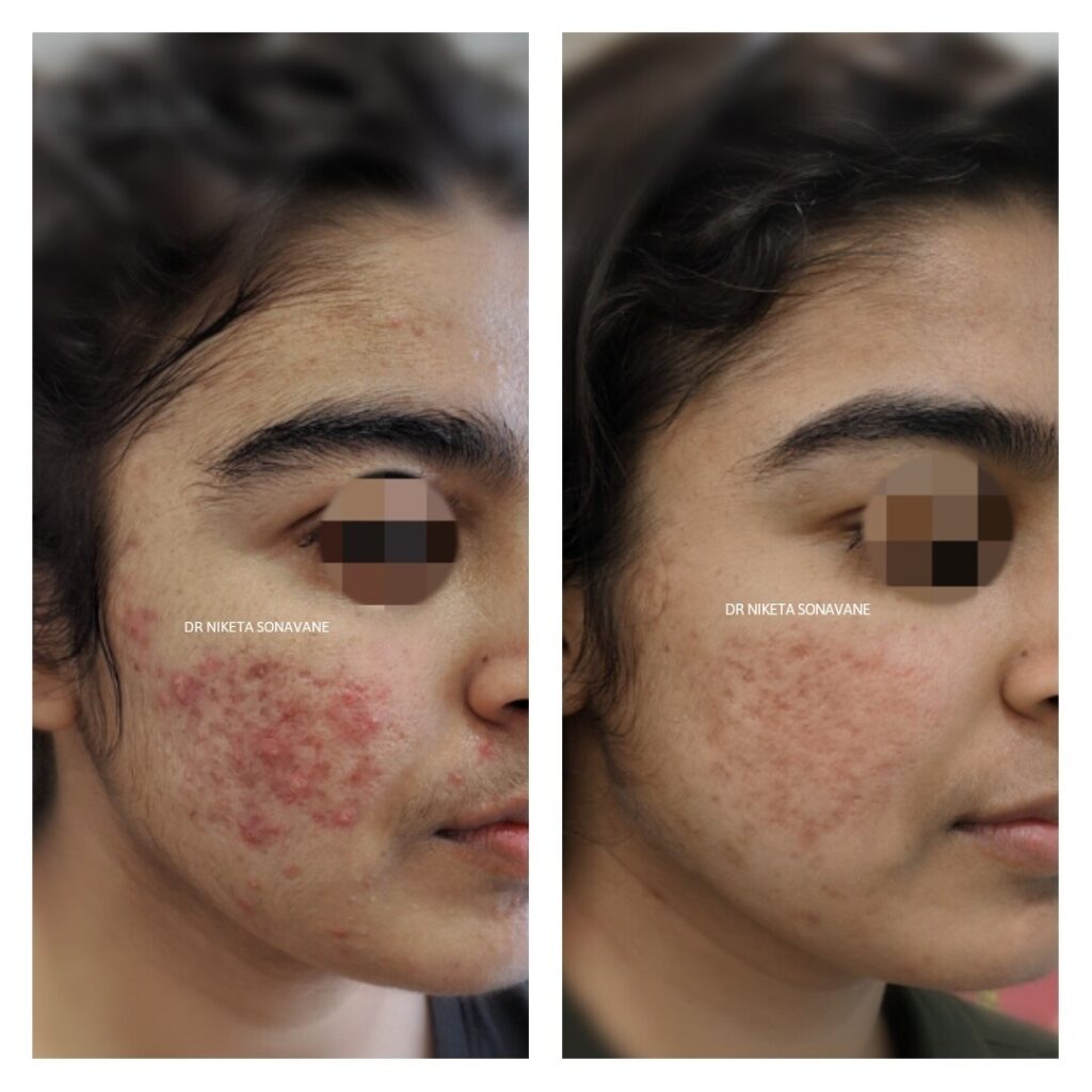 Acne Treatment in Mumbai Acne Treatment in Mumbai