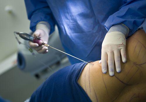 Liposuction in Mumbai Liposuction in Mumbai