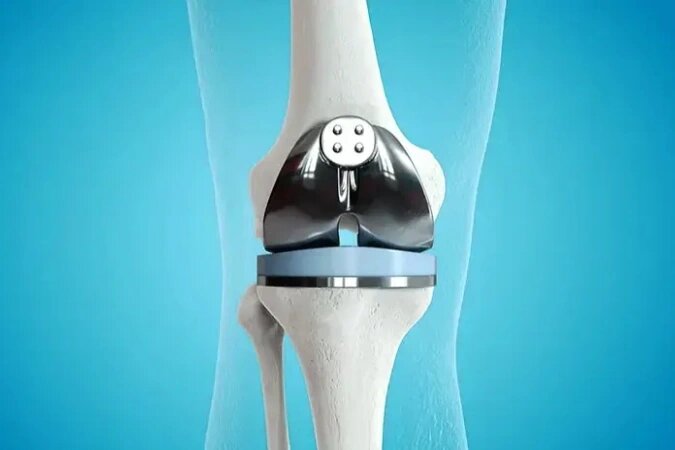 Knee Replacement in Sharjah Knee Replacement in Sharjah