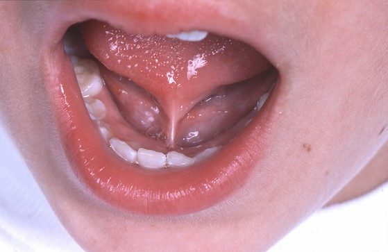 Tongue Tie Surgery Cost in Mumbai Tongue Tie Surgery Cost in Mumbai