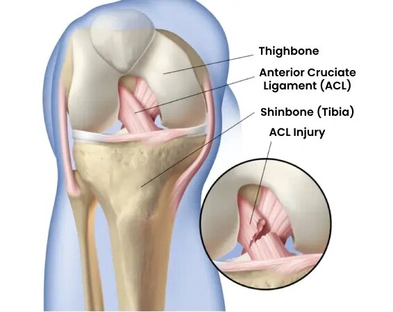 ACL Reconstruction surgery in Dubai ACL Reconstruction surgery in Dubai
