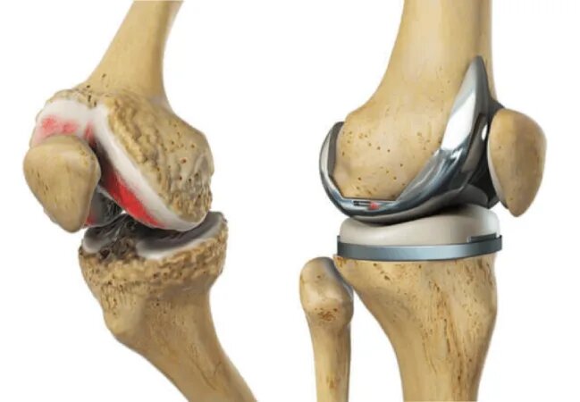 Knee Replacement Surgery in Dubai Knee Replacement Surgery in Dubai