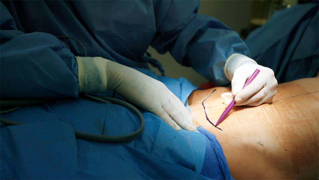 Tummy Tuck surgery in Mumbai Tummy Tuck surgery in Mumbai