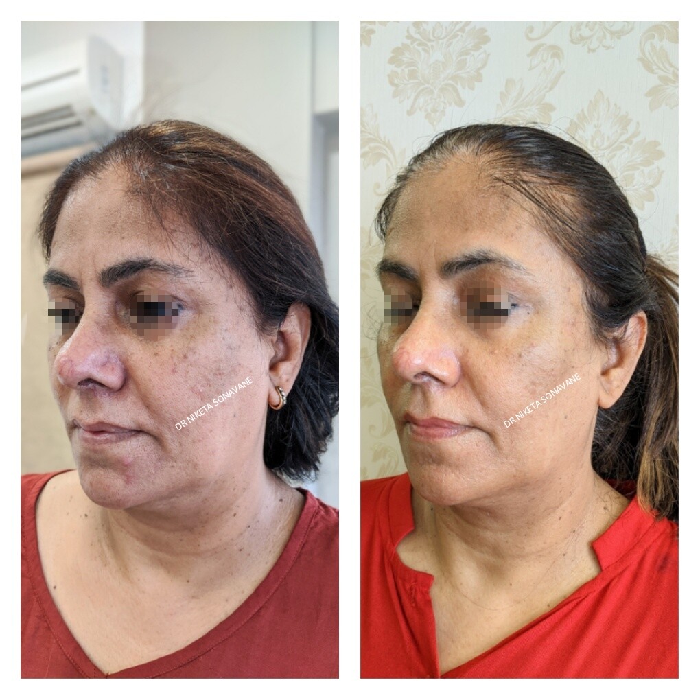 Anti Aging Treatment in Mumbai Anti Aging Treatment in Mumbai