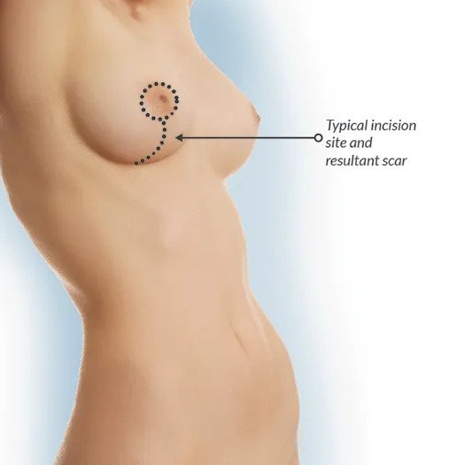 Breast Lift Surgery in Mumbai Breast Lift Surgery in Mumbai