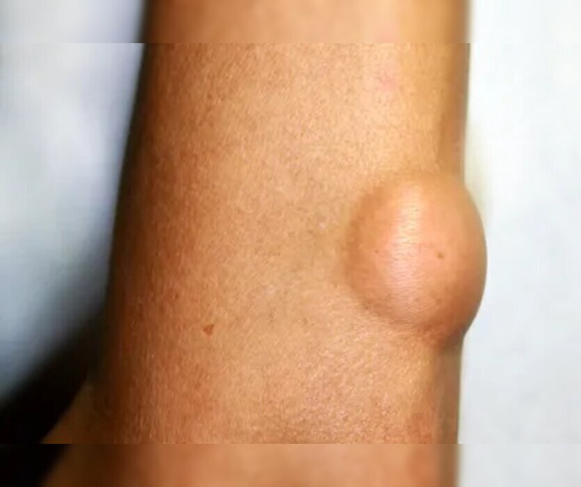 Lipoma Removal Surgery in Navi Mumbai Lipoma Removal Surgery in Navi Mumbai