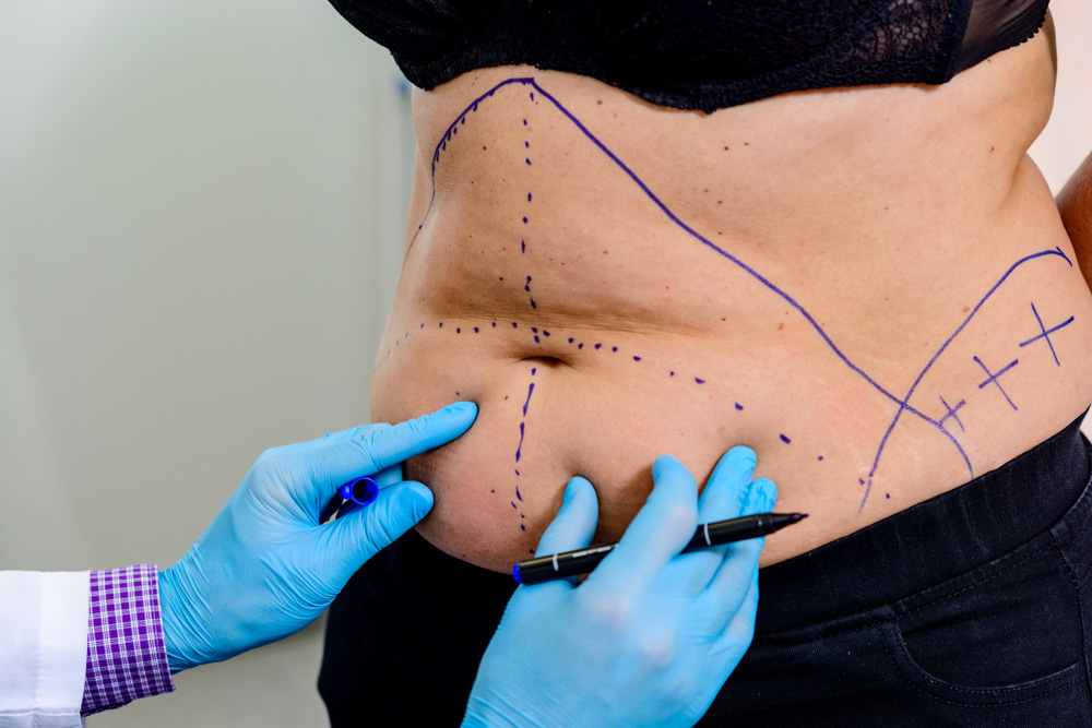 Tummy Tuck Surgery In Navi Mumbai