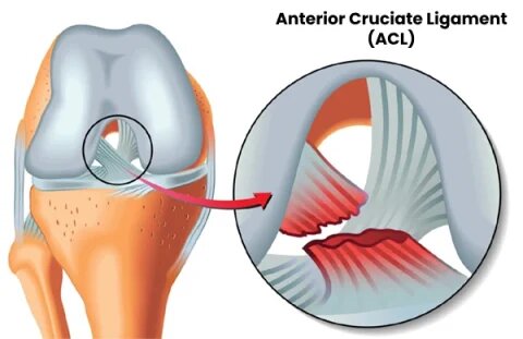 ACL Reconstruction Surgery in Dubai, UAE - Dr. Azam Badar Khan