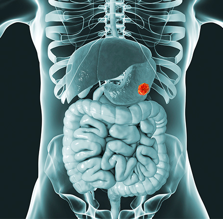 Gastric Cancer Treatment in Mumbai Gastric Cancer Treatment in Mumbai