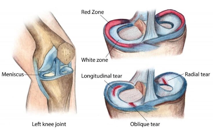 Meniscus Repair in Dubai
