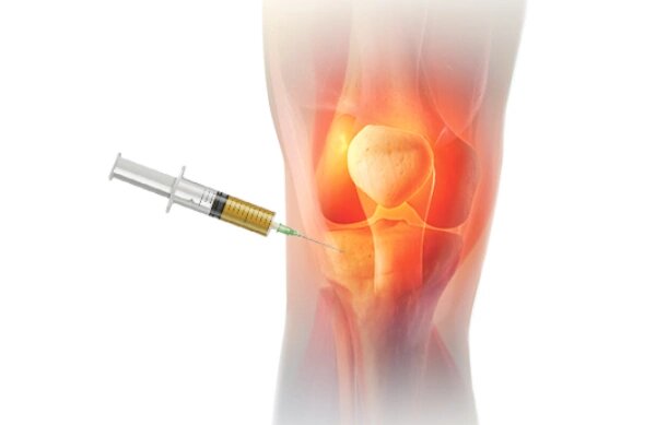 PRP Injections for Knee in Dubai, UAE PRP Injections for Knee in Dubai, UAE