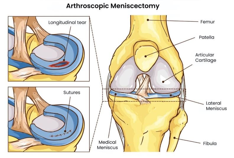 Arthroscopic Meniscus Surgeries in Banglore Arthroscopic Meniscus Surgeries in Banglore