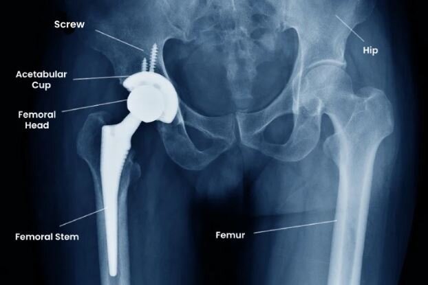 Total Hip Replacement Surgery in Banglore