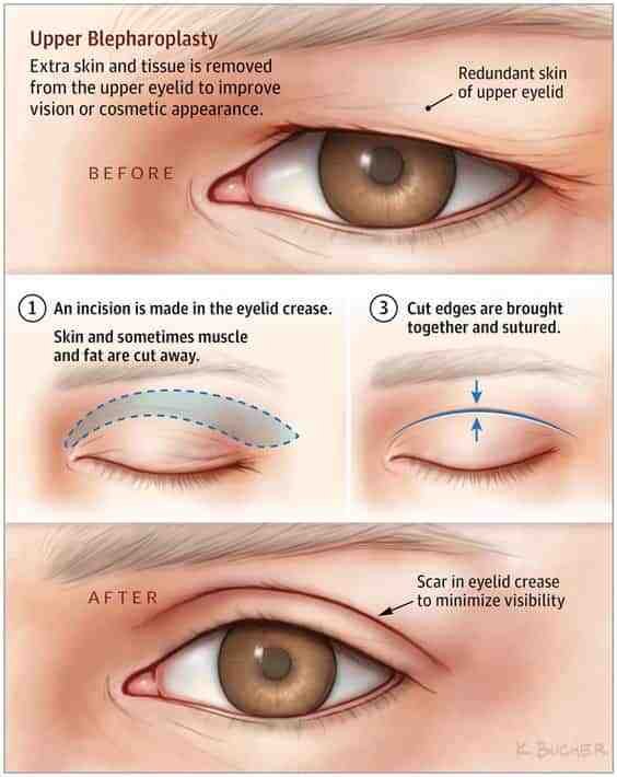 Eyelid Surgery in Mumbai: Dr. Siddharth Prakash