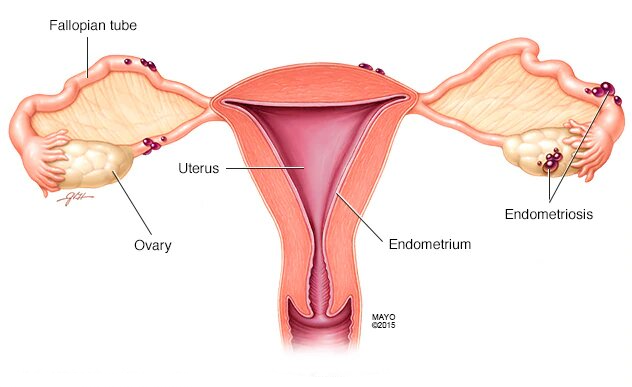 Best Doctors for Endometriosis in India - Dr. Anshumala Shukla Kulkarni Best Doctors for Endometriosis in India - Dr. Anshumala Shukla Kulkarni
