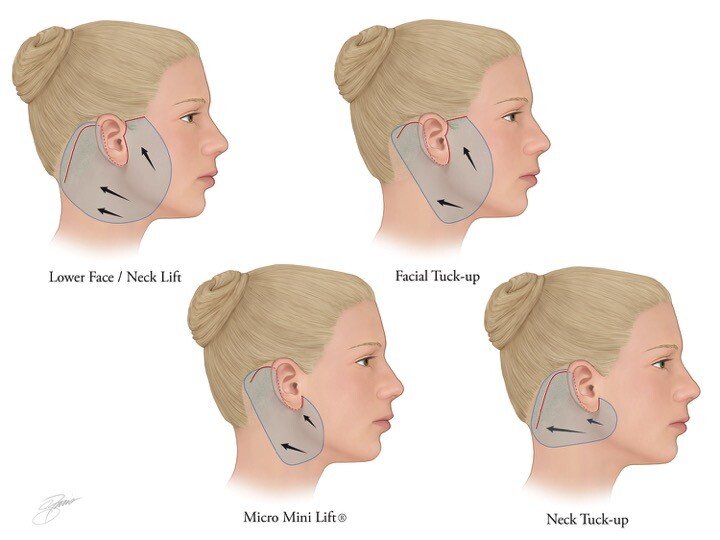 Facelift Surgery in Mumbai – Dr. Siddharth Prakash Facelift Surgery in Mumbai – Dr. Siddharth Prakash