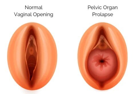 Pelvic Organ Prolapse Surgery in Mumbai: Dr. Maitreyee Parulekar