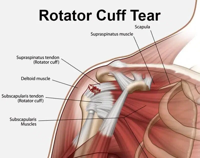 Arthroscopic Rotator Cuff Repair in Bangalore: Dr. Ponnanna K.M