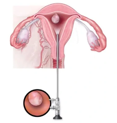 Hysteroscopic Myomectomy in Mumbai — A Modern Solution by Dr. Maitreyee Parulekar Doctor Near Me Hysteroscopic Myomectomy in Mumbai — A Modern Solution by Dr. Maitreyee Parulekar Doctor Near Me