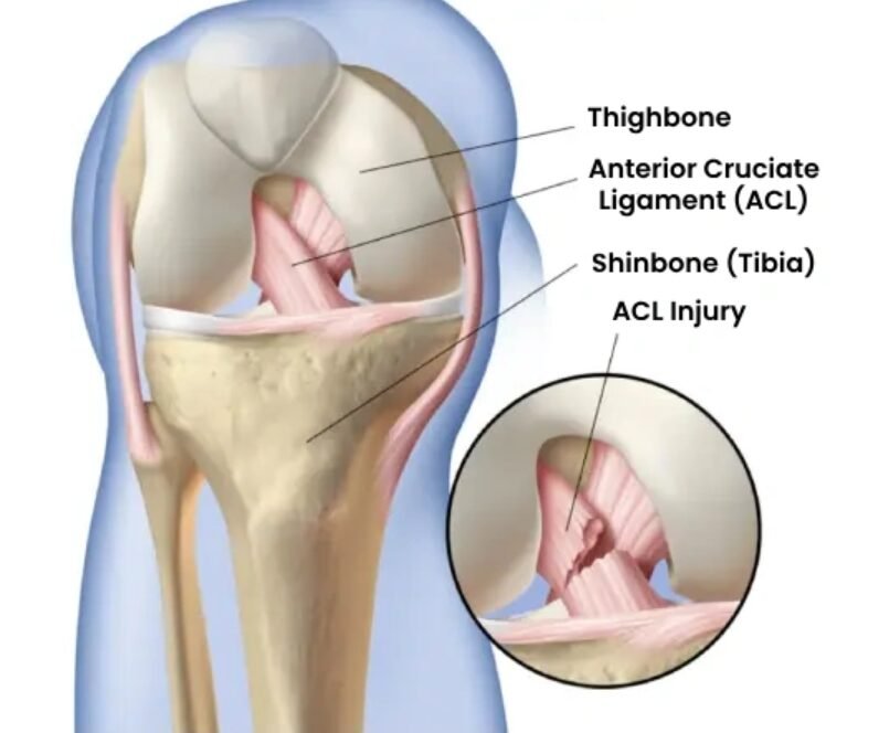 ACL Reconstruction Surgery in Dubai, UAE ACL Reconstruction Surgery in Dubai, UAE