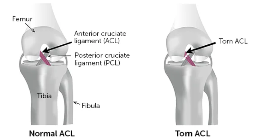 ACL Reconstruction Surgery in Dubai ACL Reconstruction Surgery in Dubai