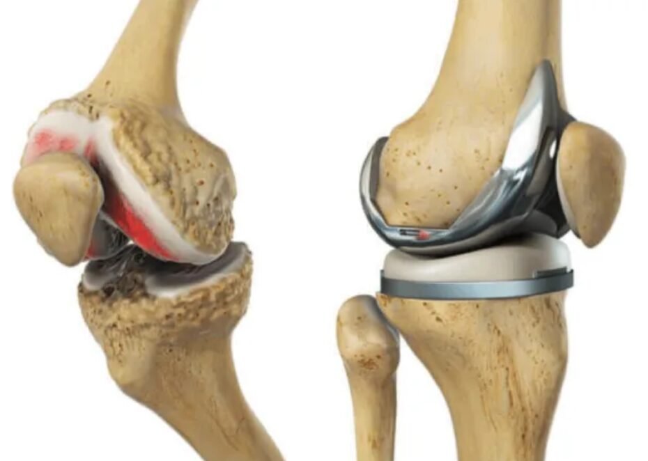 Knee Replacement Surgery in Dubai, UAE Knee Replacement Surgery in Dubai, UAE