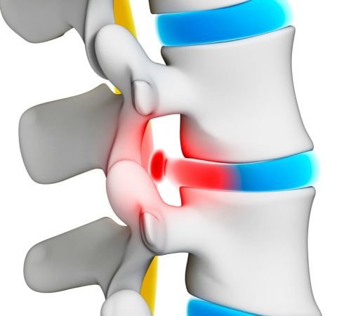 Best Doctor for Slip Disc in mumbai Best Doctor for Slip Disc in mumbai