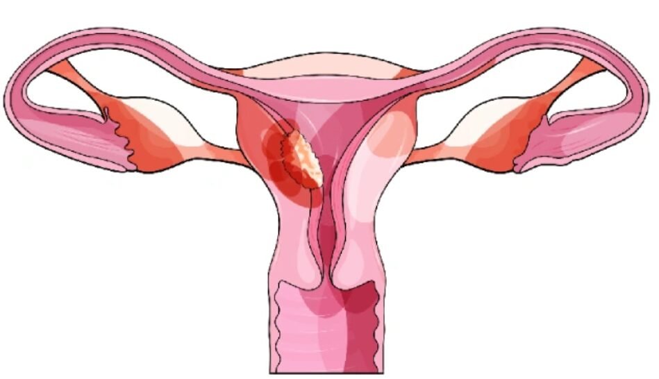 Uterine cancer surgery in Mumbai Uterine cancer surgery in Mumbai