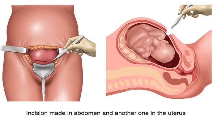 C Section Delivery Doctor in Thane C Section Delivery Doctor in Thane