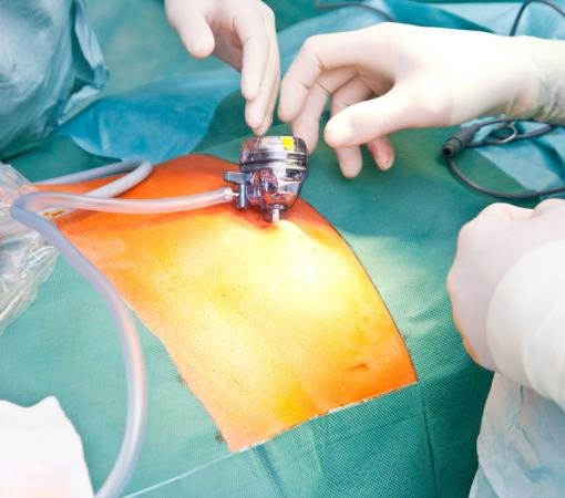 Minimally Invasive Spine Surgery Minimally Invasive Spine Surgery