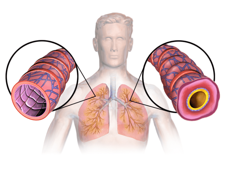 Asthma Specialist in Mumbai Asthma Specialist in Mumbai