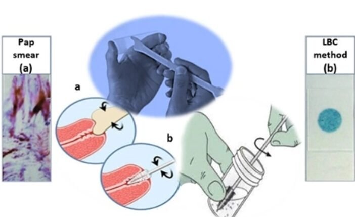 Cervical Cancer Screening in Mumbai Cervical Cancer Screening in Mumbai